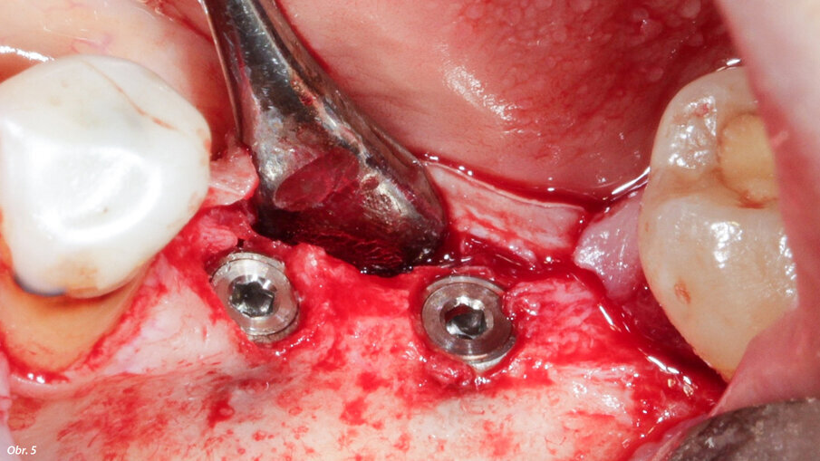 Malá tloušťka zbytkové kosti ve vestibulární oblasti implantátů.