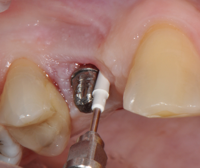 Fig.8: Implant surface debridment with piezo-ceramic device and PEEK tip.