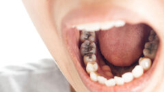 Amalgam versus composite: UK study warns of care crisis over 2034 phase-out