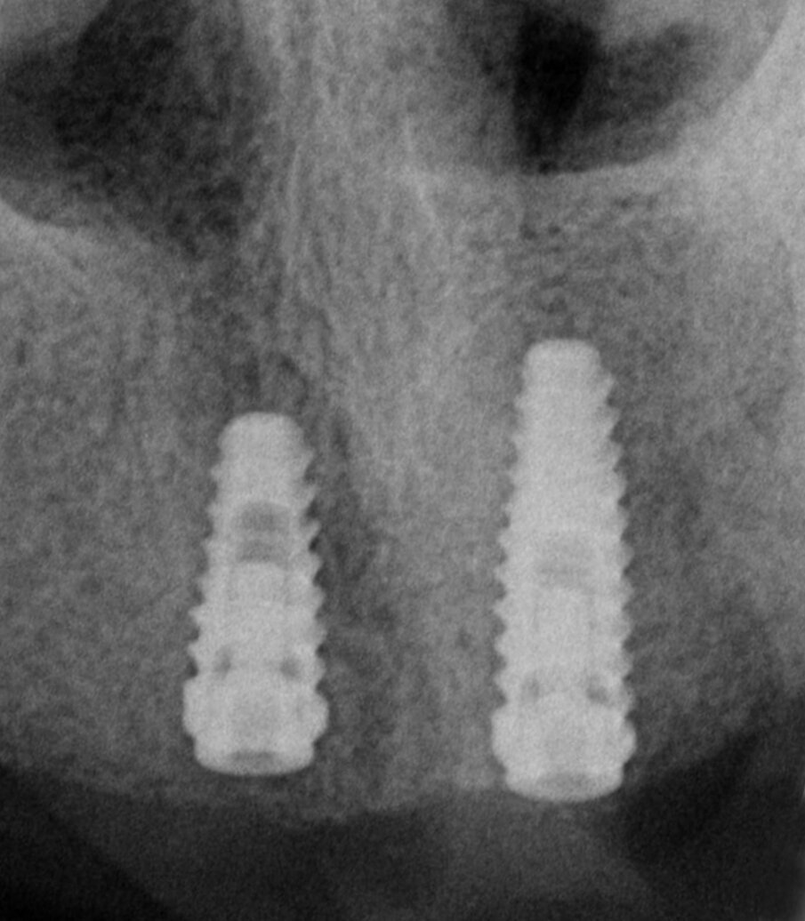 Fig. 8 - Rx endorale dopo sostituzione impianto.