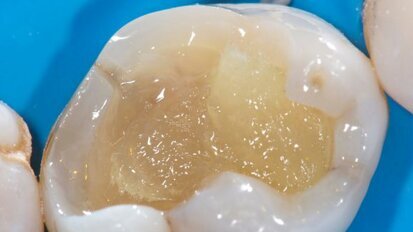 Continued education: Cavity restoration with fibre reinforced composites