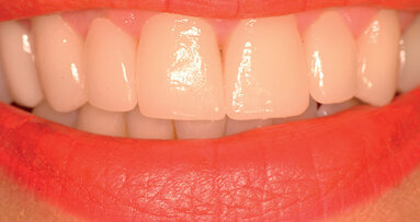 Estetica e CAD/CAM un binomio vincente