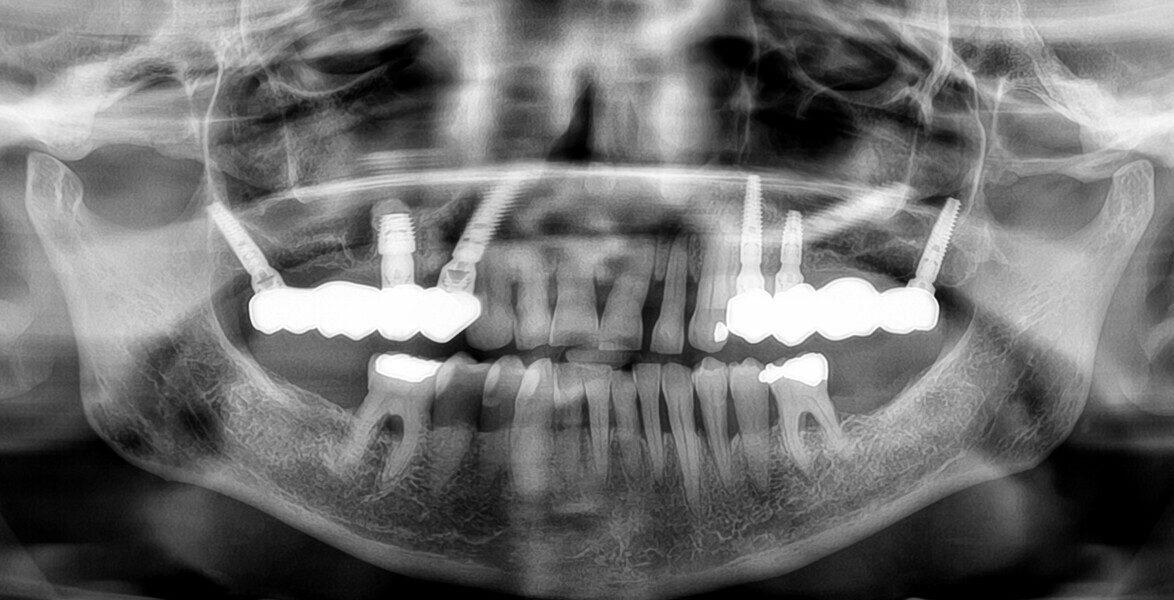 Fig. 17: Final radiograph.