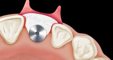 Analisi critica dei fattori di rischio estetici in implantologia post-estrattiva e introduzione di un nuovo parametro clinico-diagnostico