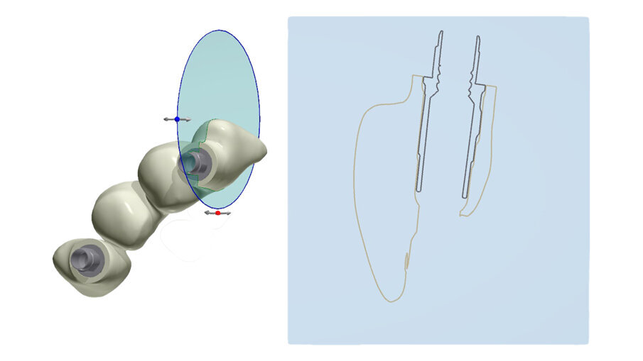 Fig. 39_Il progetto digitale consente all’odontotecnico di definire a livello circolare i limiti e gli spessori di rispetto della Zirconia.