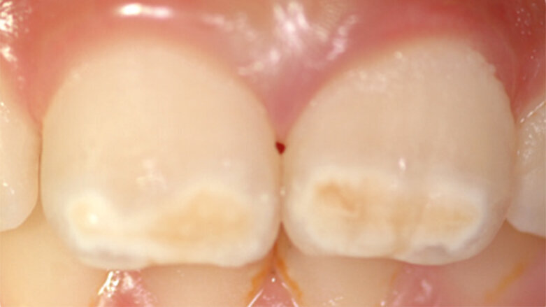 Molárová a incizální hypomineralizace skloviny