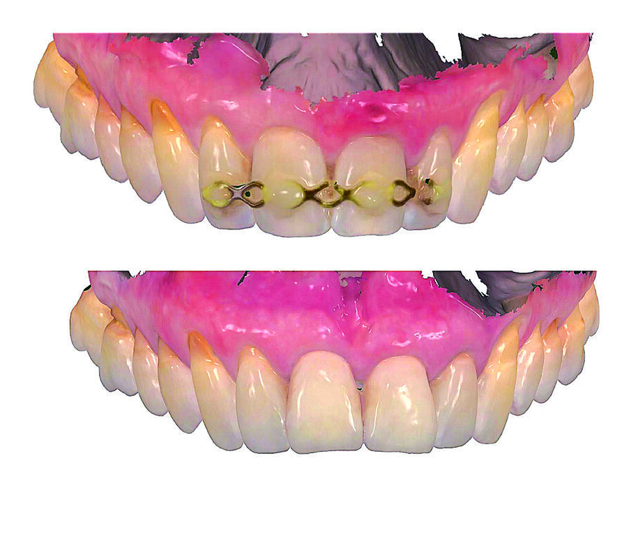 Slika 14. Usporedba tijeka gingive prije (gore) i poslije (dolje) implantacije s pomoću intraoralnog skena