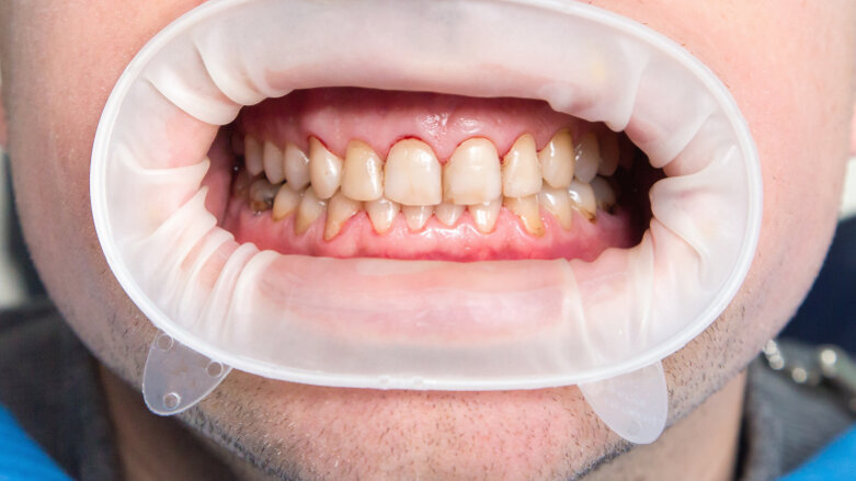 New study offers mechanistic view of dental fluorosis occurrence