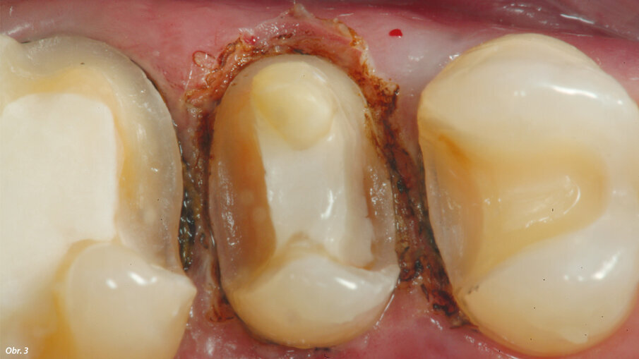 Žlábkování kolem preparace provedené diodovým laserem.