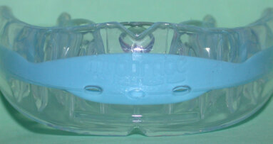 Myobrace: riflessioni, metodi di applicazione e caso clinico