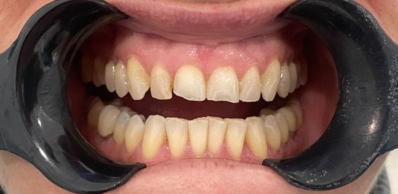 Fig. 4: Intra-oral pre-treatment photograph.