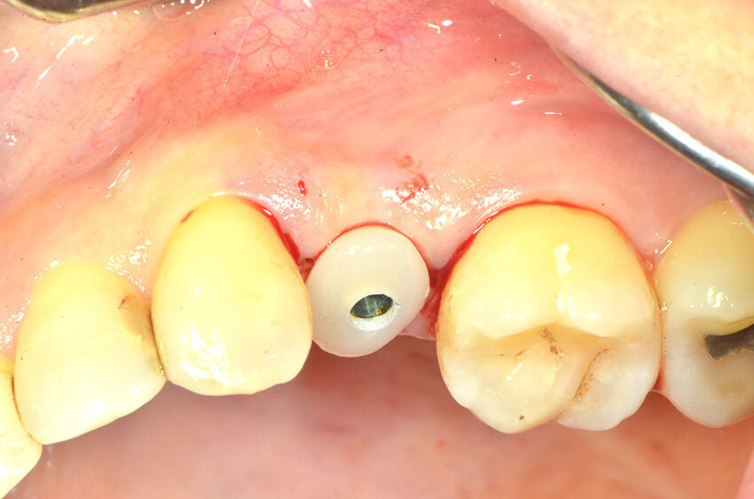 Fig. 12a_La vite custom serrata post operatoria.