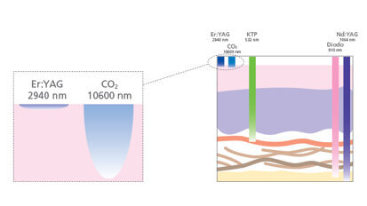 Dispositivi orali e laser per il russamento