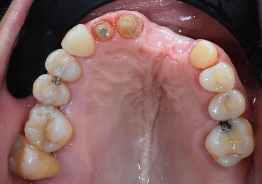 Fig. 13 - Visione occlusale che evidenzia l’incremento dello spessore dei tessuti molli.