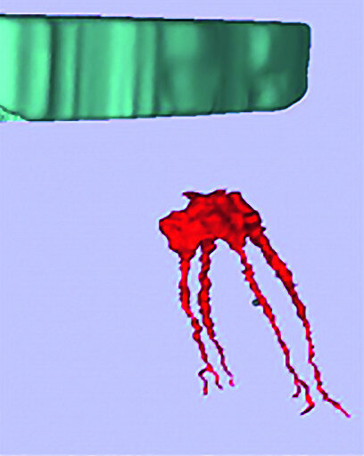 Figs. 11a–c : Depuis la gauche : plan de traitement virtuel pour un accès endodontique guidé par scanner (CT-GEA). La dent à traiter est segmentée par le scanner volumique, des trajets d’accès idéaux sont tracés au travers de la face occlusale de la dent, et un guide de forage CT-GEA est imprimé en 3D.