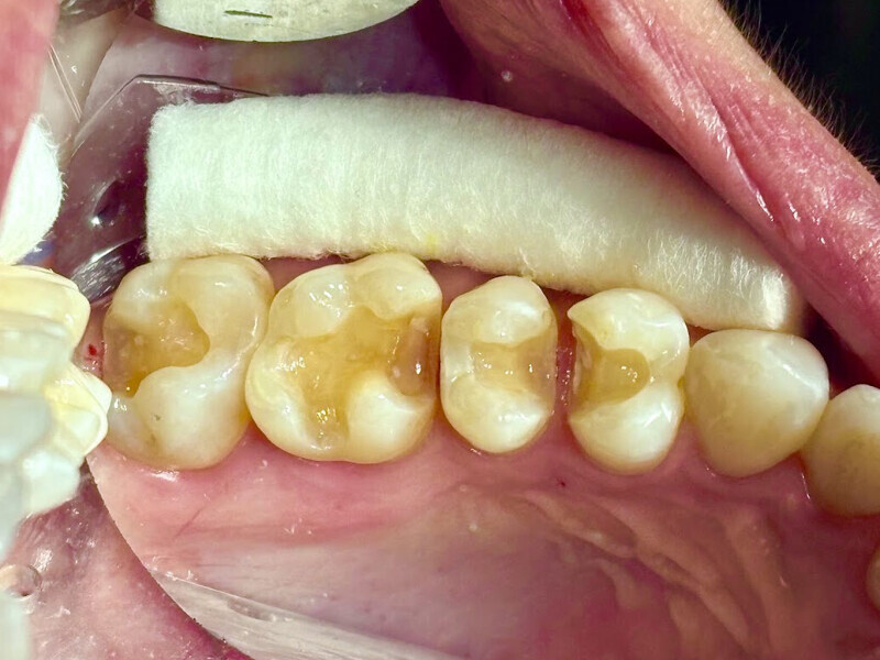 Fig. 22: Teeth in the maxillary right posterior sextant after removal of the old composite restorations and caries.