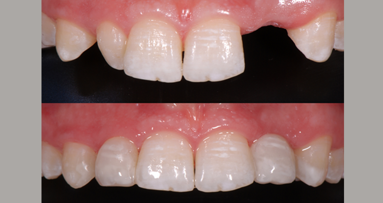 Beste Zahnrekonstruktion: 1. Platz geht nach Witten