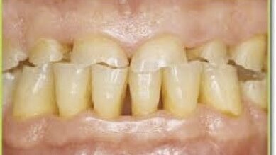 Terapias para el bruxismo