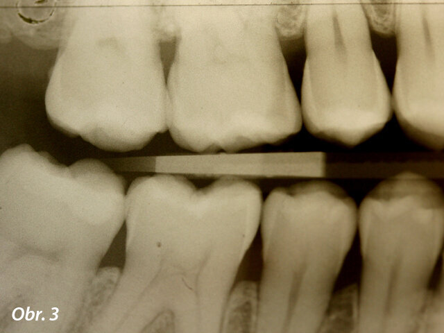 RTG snímek typu bitewing pravého úseku.