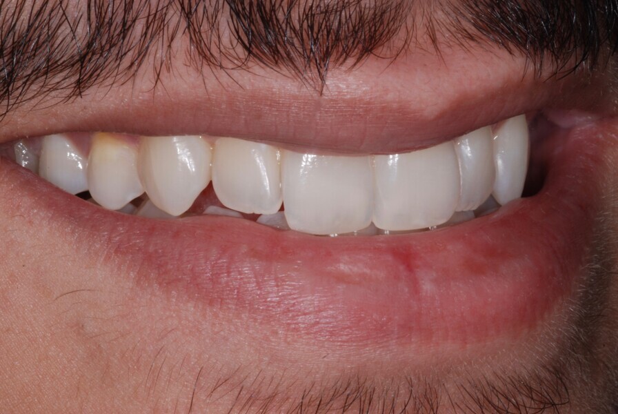 Fig. 30: Smile right side view after treatment.