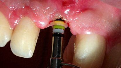 Misuratore universale di bordo gengivale: sistema graduato-millimetrico per misurare visivamente la profondità di un impianto