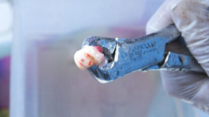 Figura 3. Diente fuera de boca tras exodoncia atraumática. Figura 3. Diente fuera de boca tras exodoncia atraumática.