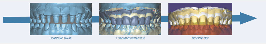 Fig. 6: Scanned data of the final preparation. Fig. 7: Superimposed scanned data of the prepared model and the model with the provisional crowns. Fig. 8: Slight adjustments during the design phase