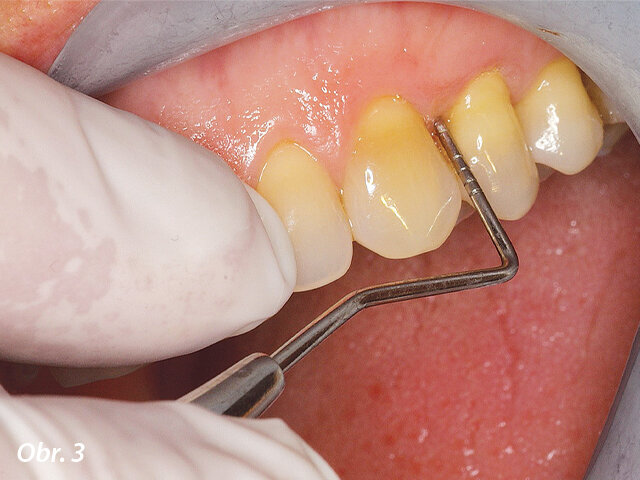 Parodontologická sonda v ošetřené oblasti: nebyla prokázána přítomnost parodontálních kapes a pacientka byla schopna opět řádně pečovat o své ústní zdraví.