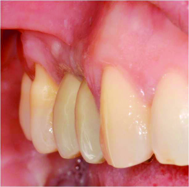 Fig. 12-14_Corone definitive e rx di controllo a due anni dalla chirurgia.