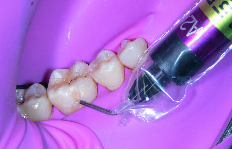 Fig. 10. Buccal pit on tooth #46 was directly filled with Beautifil Injectable X shade A2.