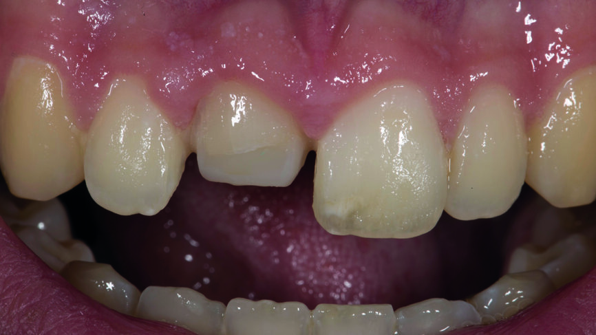 Fig. 1 : Vue intra-orale, montrant la préparation dyschromique.