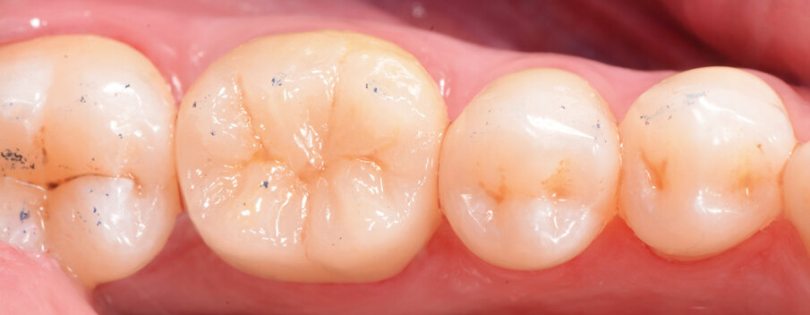 Figs. 12a & b: Lateral and occlusal views of the completed restoration.