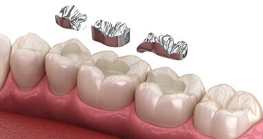 Keine Lösung in Sicht: Verhandlungen über Amalgam-Ersatz abgebrochen