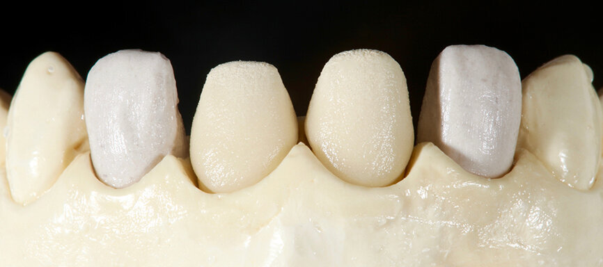Fig. 8. Se llevó a cabo la primera cocción de dentina con VITA VMK Master LUMINARY 1 (blanco) y 4 (marrón-naranja claro).