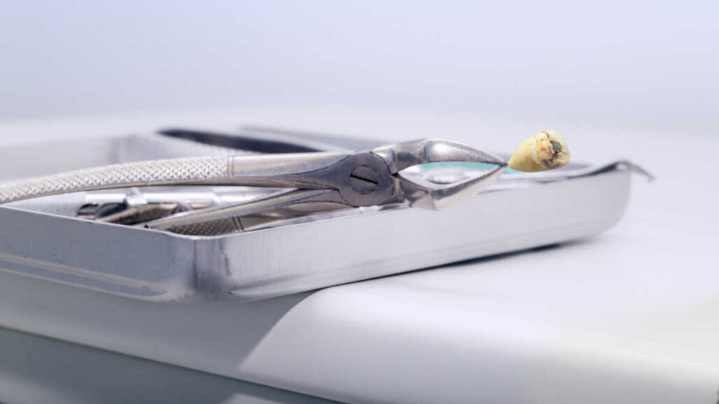 Instalações odontológicas estimuladas a usar separador de amálgama