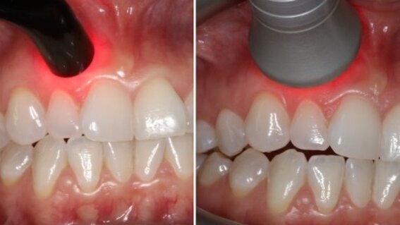 Fotobiomodulacja jako narzędzie wspomagające gojenie ran po leczeniu chirurgicznym