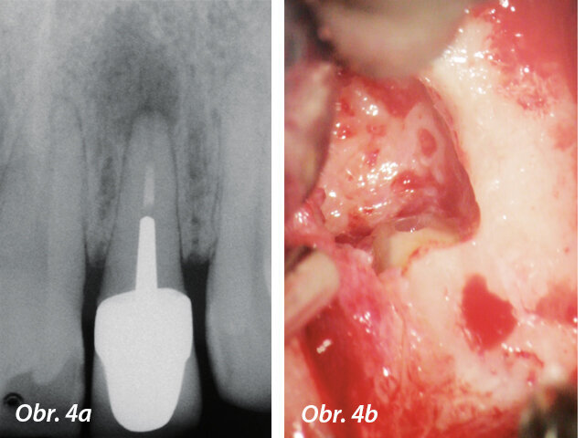Předoperační RTG s velkým periradikulárním nálezem a periapikální chirurgie