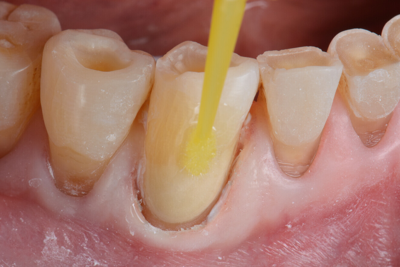 Fig. 3b : EQUIA Forte Coat crée une surface lisse,