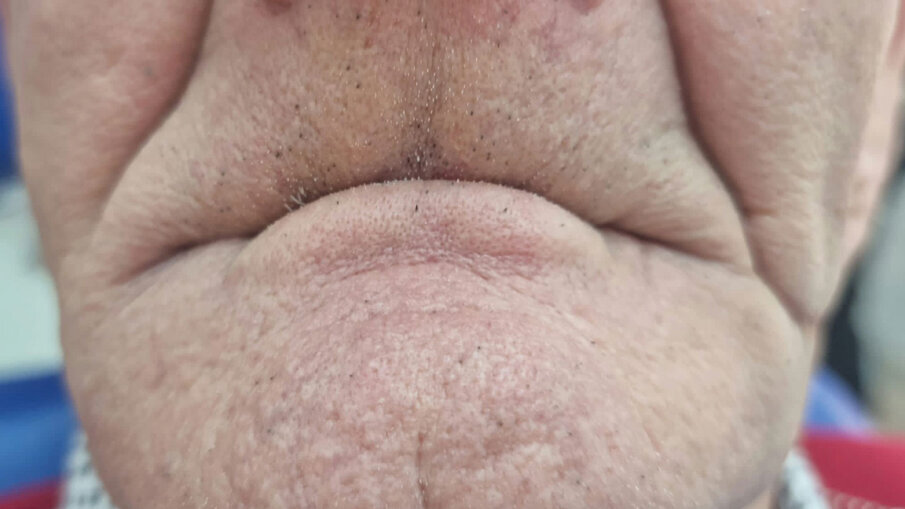 Fig. 11 - Fotografia con vista frontale prima dell’inserimento dei monconi.