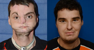Facial transplants: Researchers review development over past nine years