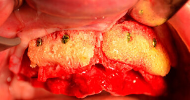 Madrid 2-3 giugno 2016: seminario di approfondimento formativo teorico-pratico di alta chirurgia su dissezione anatomica