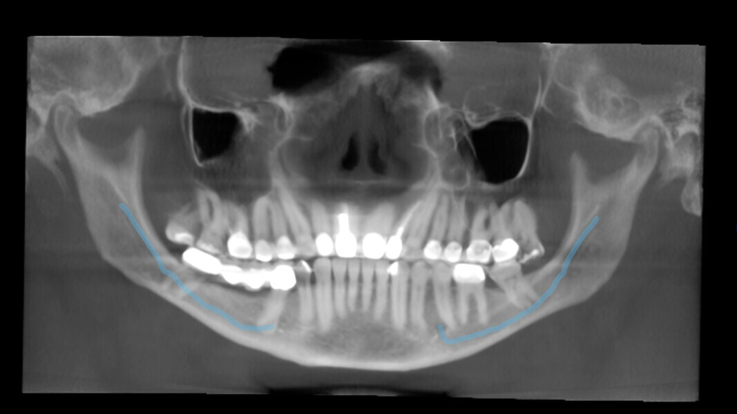 Fig. 13: Tracing of the trajectory of the mandibular canal.
