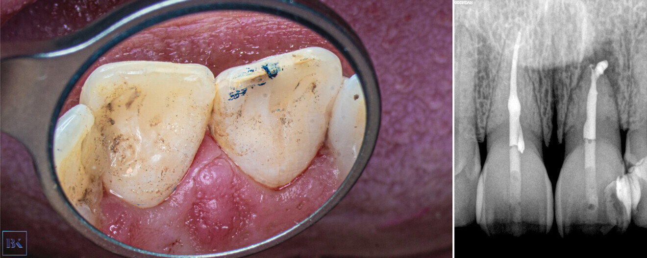 Figs. 21a & b: Occlusal check (a) and the control radiograph of the composite seal (b).