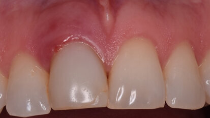 La regeneración alveolar en dientes anteriores