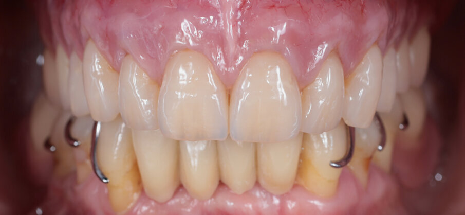 Figs: 12. Upper and lower dentures in situ. The customized pink and white esthetic effects make the dentures look very natural – the teeth look as though they have grown from the gums like natural teeth.