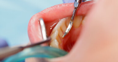Study offers new insights into dental caries development and prevention