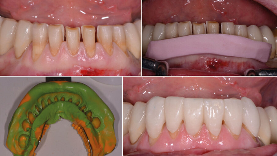 Fig. 8 - Preparazione delle faccette con dima di controllo e provvisorio.