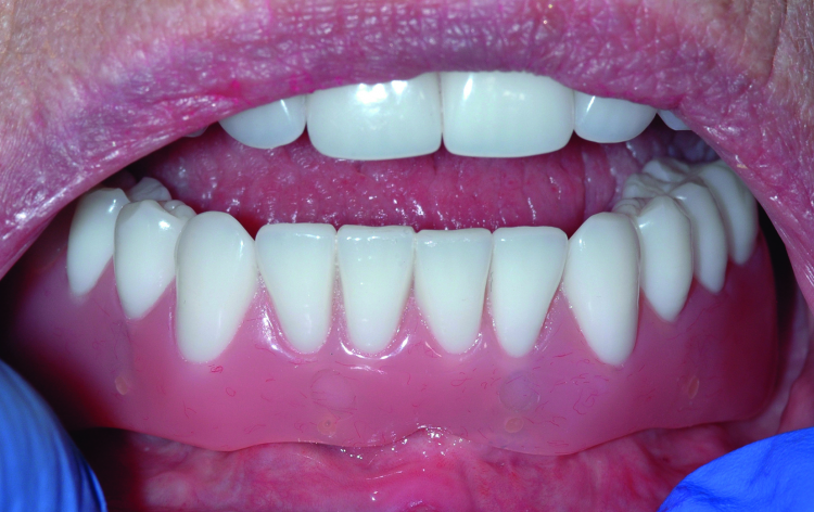 Fig. 20: Completed bridge in place showing flange length suitable to prevent food entrapment and support the lip and cheeks. Because the restoration remains removable, these flanges do not prevent excellent home care.