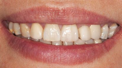 Anterior BruxZir Solid Zirconia Crown