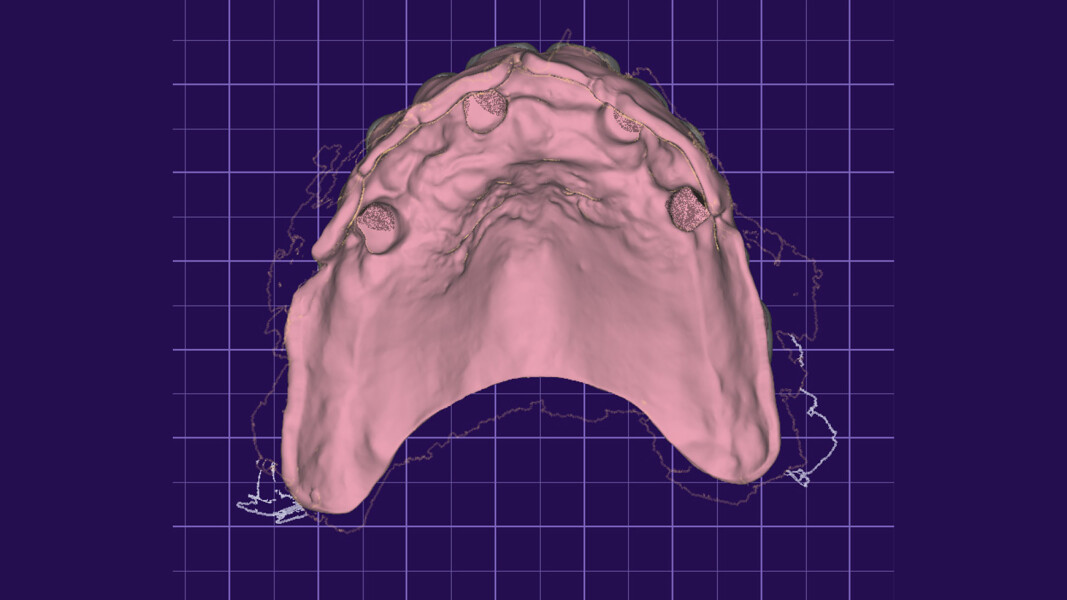 Fig. 18_Visione interna del progetto protesico digitale, condivisa con clinico e paziente per eventuali correzioni prima della realizzazione.